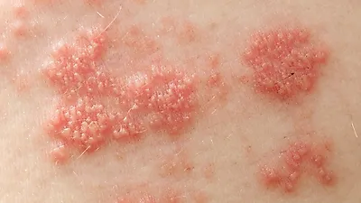 초기 진료가 중요한 통증의 왕이라 불리우는 대상포진 증상