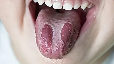 [구강건강관리]  혀가 쩍쩍 갈라지는 원인이  나의 건강상태 문제일 수도 있다니… '혀 갈라짐' 원인과 증상  혓바늘 원인 및 증상 치료법 까지