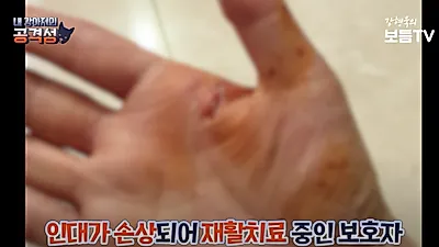 [연구] 개에게 물린 후…큰 상처 및 심리적 타격 남아