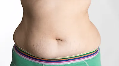 튼살 및 주름살 개선 노하우, 어떤게 있나?