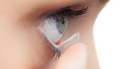 각막 손상 없는 '렌즈 삽입술' 라식·라섹과 차이는? 렌즈 삽입술 가격과 회복 기간까지