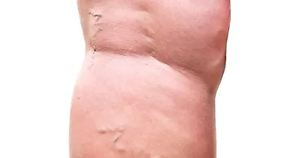 사소한 습관이 다리부종·하체부종을 제거한다