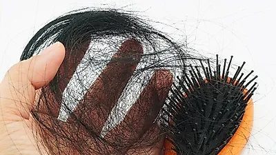탈모샴푸, 탈모 치료에 얼마나 효과 있을까? 모발이식 비용은?
