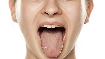 균열설 원인에 다른 치료법까지…쩍쩍 갈라지는 혀 갈라짐 원인,  내 건강상태때문?