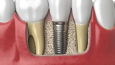 [치료꿀tip]   소중한 치아 잃었다면   '임플란트 VS 틀니', 나에게 맞는 치료방법은?