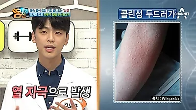 '나는몸신이다' 김도균, '콜린성두드러기+지루피부염+성인여드름' 원인은 상열? 얼굴열 내리는 팩으로 다스리기