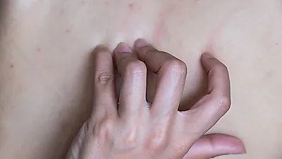 '닿기만 해도 찌릿'  눈물이 나올 정도로 아프다는  '대상포진' 초기증상이 뭐길래?... '대상포진' 원인 및 증상  '대상포진'도 예방주사가 있다?