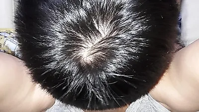 [음식효능]  '털갈이 하는 동물처럼 머리가 빠져'…하얀 두피가 그대로 보이는  원인 알고나면  극복할 수 있어