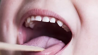 [혀로보는 건강]  혓바닥이 바싹 마르고 갈라지는 원인이  건강때문이라고?… '혀 갈라짐'과  혓바늘 치료 Tip