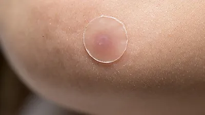 여드름 흉터 없애는 법에 여드름 패치 쓸까 피부과 관리받을까?