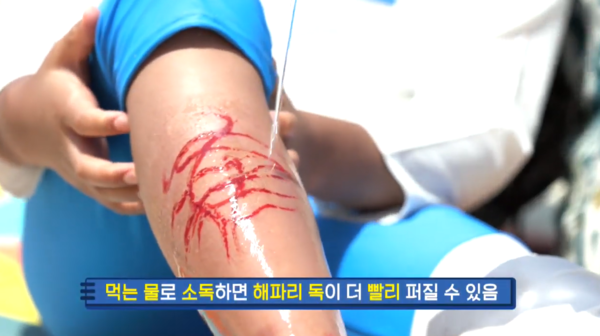 ▲독성 해파리에 쏘일 경우 생수가 아닌 바닷물에 소독해야 한다 [사진출처=EBS Clipbank 공식 유튜브 채널]