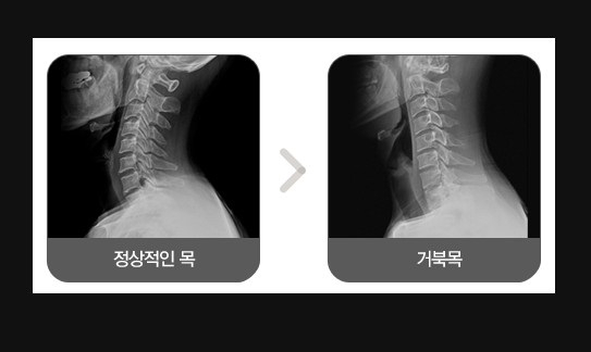 스마트폰 유저들은 거북이? 거북목증후군 방치하면 목디스크까지!