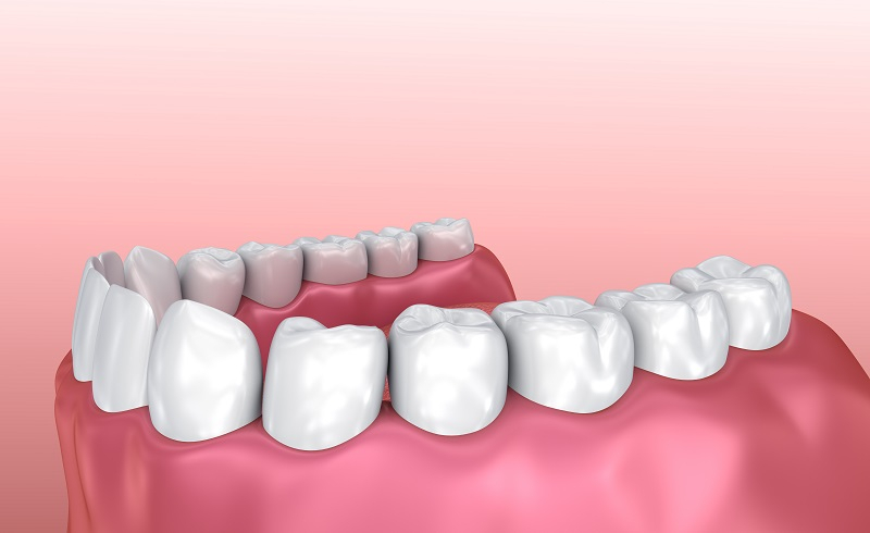 치주염 증상과 치료, 양치질만 잘해도 예방 가능
