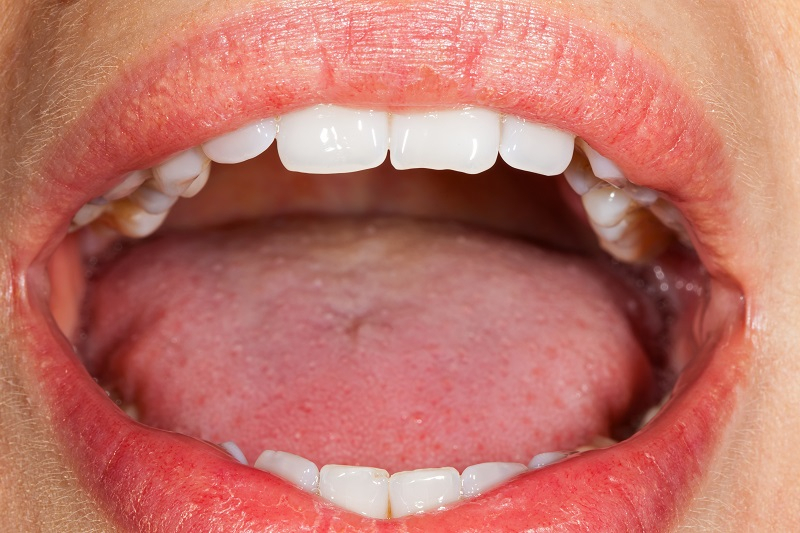 치주염 증상과 치료, 양치질만 잘해도 예방 가능