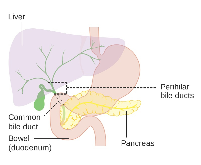 갑자기 황달이 오면 담도암 증상 가능성...담도암 말기되면 수술 불가