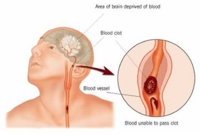 갑자기 한쪽 팔이나 다리에 힘이 없어지는 뇌졸중 전조증상...유심히 살펴서 진료 받아야