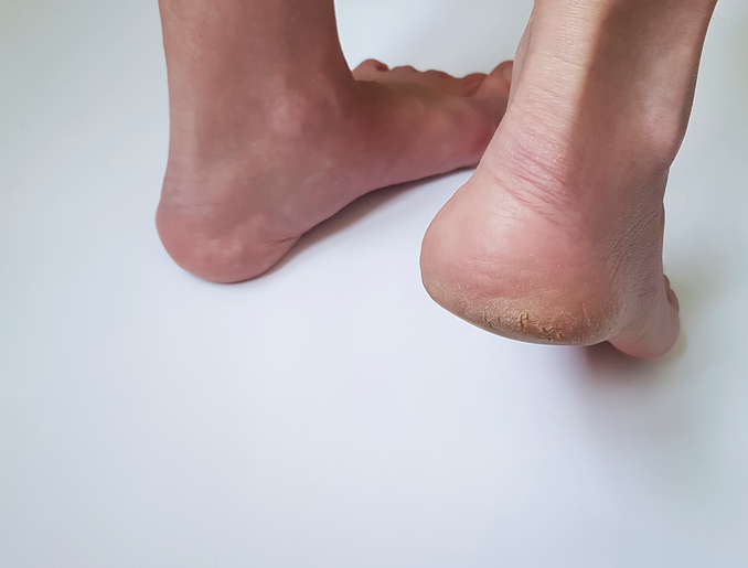 여름철 발뒤꿈치통증, 알고보니 족저근막염?..증상 및 자가치료법