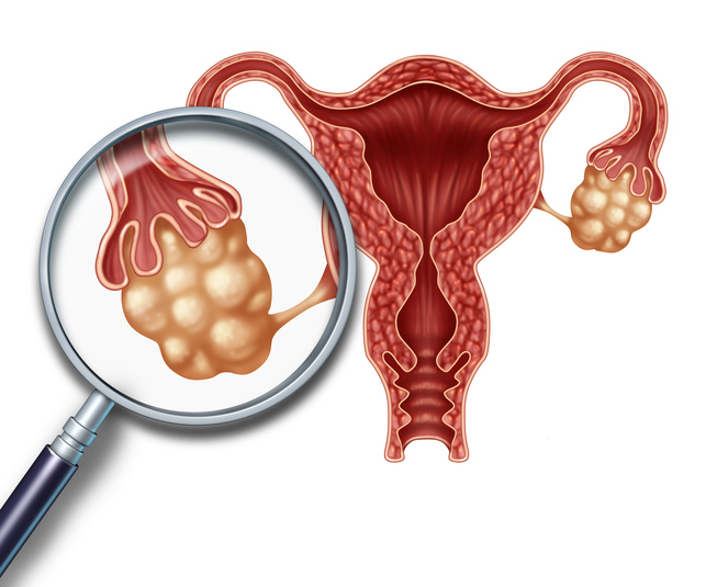 종잡을 수 없는 생리주기, 다낭성난소증후군 증상이 원인?