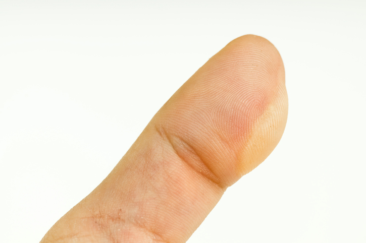 한포진의 원인과 증상, 예방방법을 알아보자