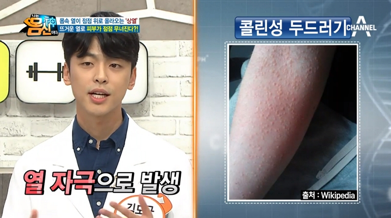 '나는몸신이다' 김도균, '콜린성두드러기+지루피부염+성인여드름' 원인은 상열? 얼굴열 내리는 팩으로 다스리기