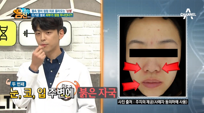 '나는몸신이다' 김도균, '콜린성두드러기+지루피부염+성인여드름' 원인은 상열? 얼굴열 내리는 팩으로 다스리기