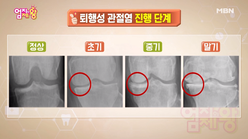무릎에서 뚝뚝 소리? 무릎통증원인, 무릎관절에 좋은 운동+음식으로 치료하기