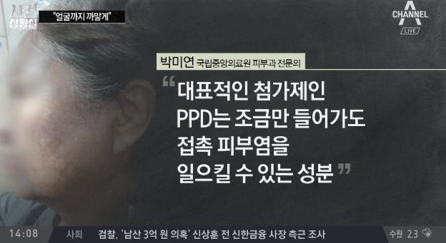 헤나염색 부작용, 대다수 다단계 업체로 유통돼 책임 묻는 일도 어려워…"죽고 싶을 만큼 괴롭다"