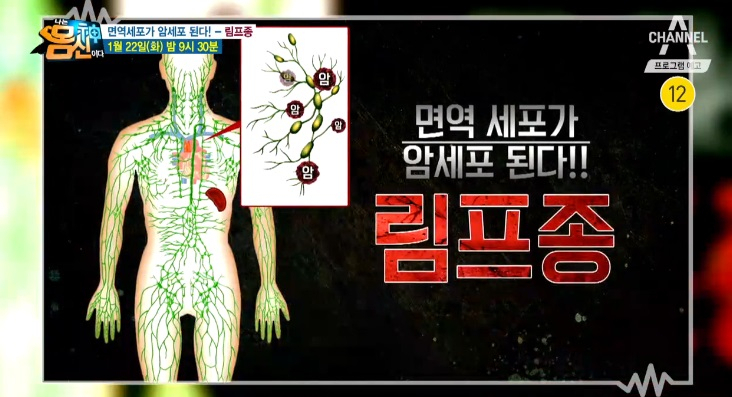 '림프종' 극복한 몸신 강림! 림프 강화 음식은?..림프종, '면역세포→암' 전신에 걸쳐 번지고 잠식해