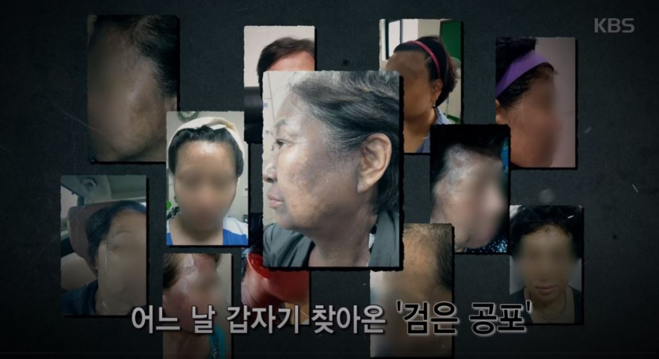 "곱게 늙고 싶었는데" 악마의 가루 헤나염색 부작용, 헤나방 천연 염색약 덜컥 믿었다가..