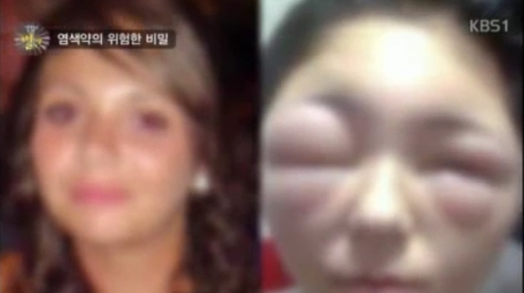 천연 헤나염색약 부작용 논란, 전문가 '패치 테스트' 중요성 강조...피해자 "완치될 기미 없다" 절망