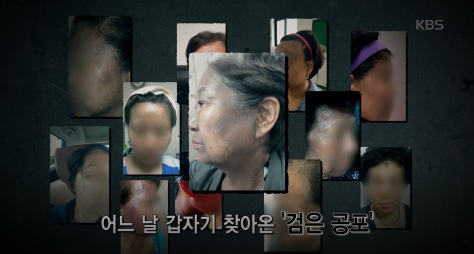 심각한 상처 남긴 '헤나염색 부작용', 공포의 검은 색소로 고통 받는 피해자들