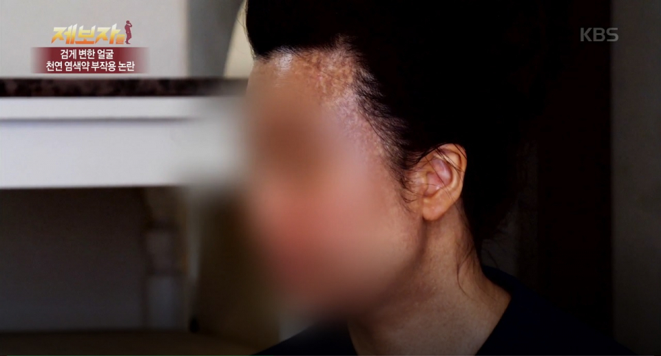 심각한 상처 남긴 '헤나염색 부작용', 공포의 검은 색소로 고통 받는 피해자들