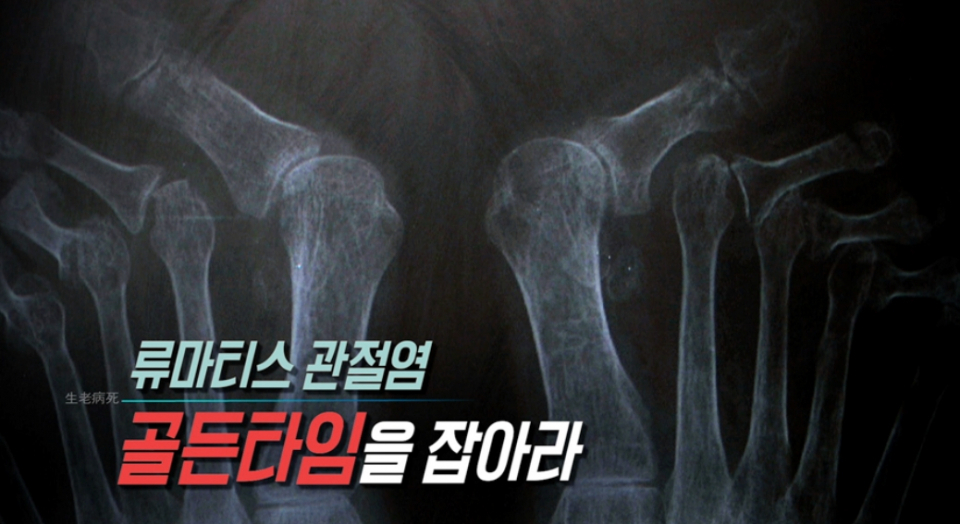 류마티스 관절염 증상 뭐길래 "어른 아이 할 것 없이 발생" 뼈를 파고드는 고통에 파스+진통제 잘못된 사용