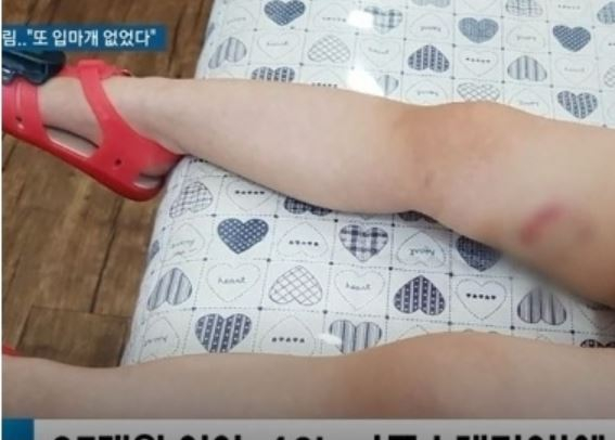 폭스테리어, 3살 여아 물어…"근본적인 원인에 대한 규명 있어야"